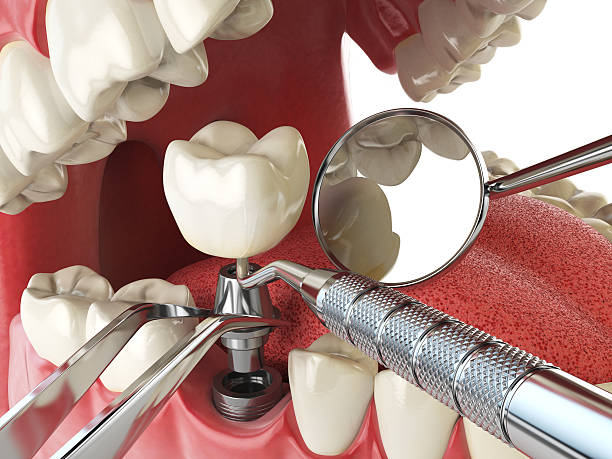 Best Emergency Dental Care for Sports Injuries in Bellevue, MI